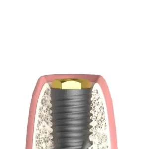 ANKYLOS® X (CX) UNIFORM BR hatszöges interface implant szintű, pozicionált