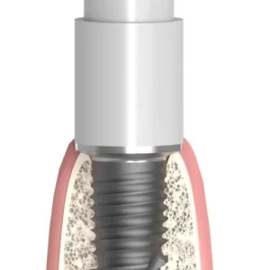 Straumann® Sin Octa® (ST) UNIFORM Multi-unit SR fej műanyag sapka titán alappal, pozicionált